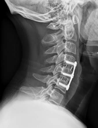 Anterior Cervical Discectomy And Fusion ACDF Radiology Reference Article Radiopaedia Org