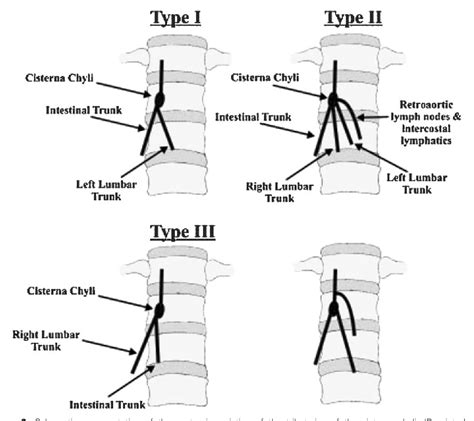 Figure 4 From Thoracic Duct Embolization For Chylous Leaks Semantic