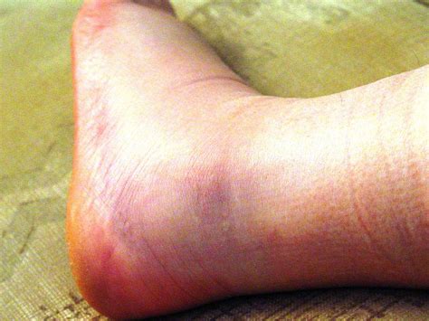 Hairline Fracture Ankle