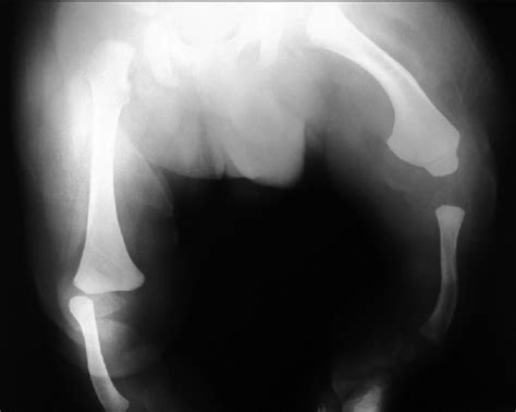 X Ray Showing Bilateral Absence Of The Tibia With Intact Fibulae And
