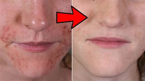 HOW TO CURE PERIORAL DERMATITIS NATURALLY AT HOME YouTube