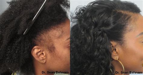 Black female hair transplant before and after. African American Hair Transplants by Dr Sean Behnam