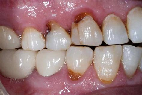 How Do You Know If You Have A Rotten Tooth Waterways Dental