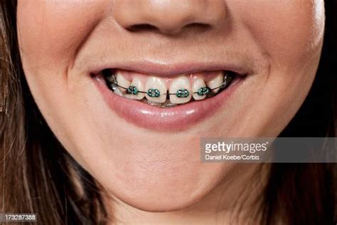 Braces Colors For Girls Teeth Photos And Premium High Res Pictures Getty Images