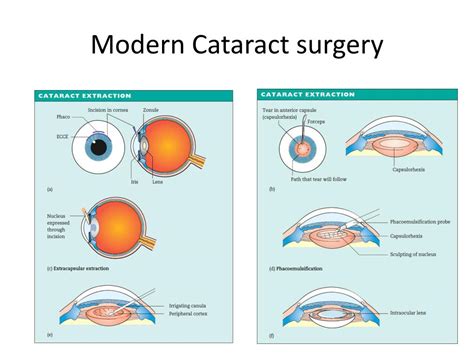 Ppt Cataract And Cataract Surgery Powerpoint Presentation Free Download Id 3518536