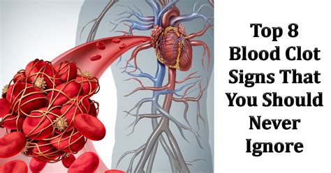Symptoms Blood Clot Warning Signs