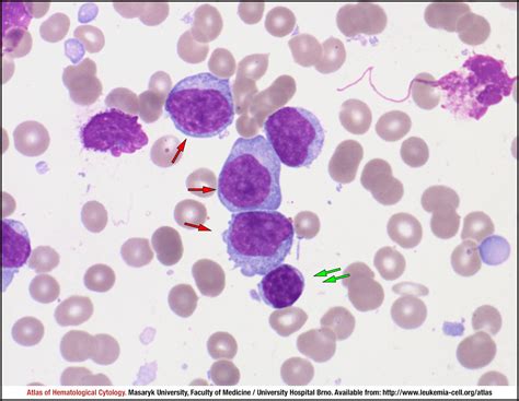 B Cell Prolymphocytic Leukaemia Cell Atlas Of Haematological Cytology