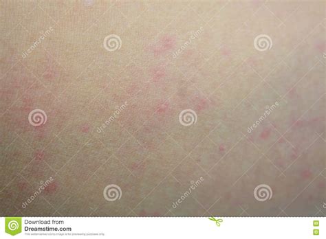 Ill Allergic Rash Dermatitis Eczema Skin Stock Image