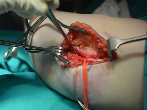 Cubital Tunnel Syndrome Surgery Cape Town And Namibia