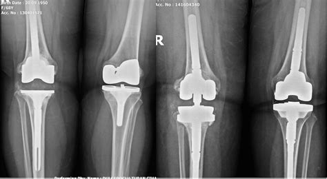 Cureus Single Staged Bilateral Revision Knee Prosthesis Results