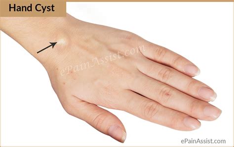 Hand Cyst Causes Symptoms Treatment