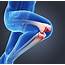 Runners Knee Pain Relief & Symptoms  Dr Scholls