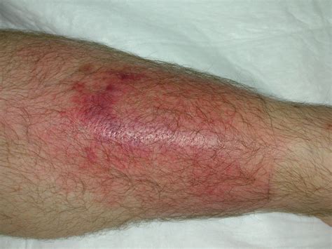 Necrotizing Soft Tissue Infection Pictures
