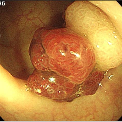 The Colonoscopy Reveals Broad Based Sessile Polyp Of 3 3 Cm In Size On