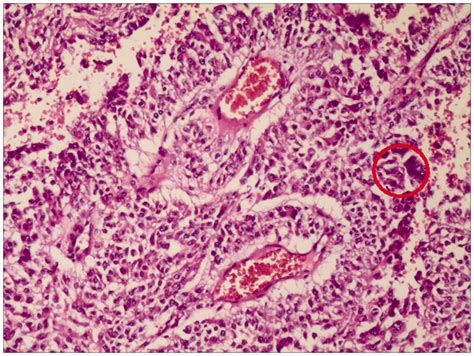 Perivascular Epithelioid Cell Tumor Pecoma Of The Kidney An Overview