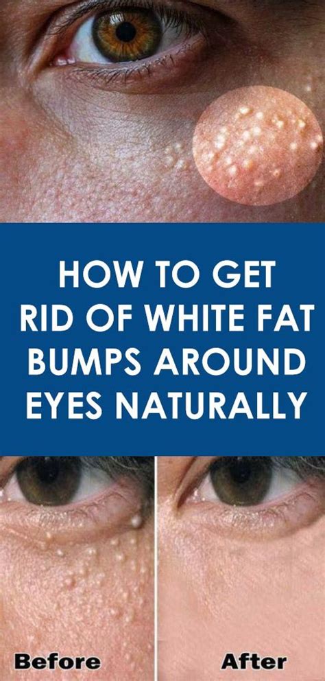 Get Rid Of Bumps Skin Get Rid Of Bumps