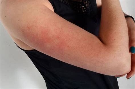 What Is Chicken Skin How To Deal With Those Red Bumps On Your Arms