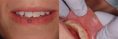 Venous Lake Lip Laser Treatment Bauer Smiles