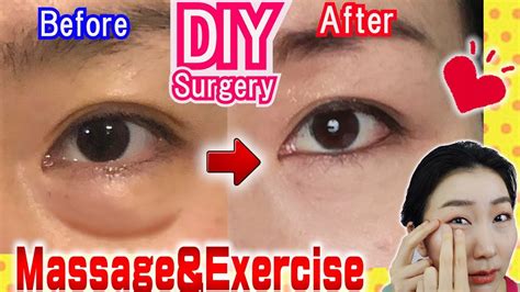 How To Remove Under Eye Bags👁️ Naturally In 7 Days Massage And Exercises🙋
