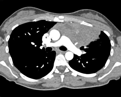 Lymphoma Involves The Chest Wall Chest Case Studies Ctisus Ct Scanning