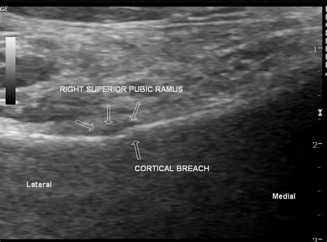 Subcutaneous Fat Contusion Ultrasound Image