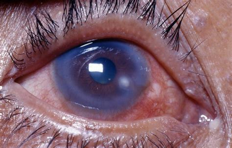 What Is A Corneal Ulcer Symptomstreatments Top Eye Doctor Near Me