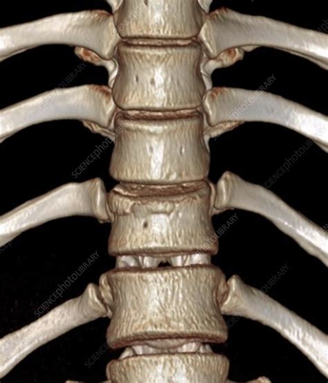 Thoracic Spine Fracture 3d Ct Scan Stock Image C0528800 Science