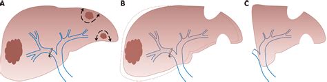 Current Strategies To Induce Liver Remnant Hypertrophy Before Major