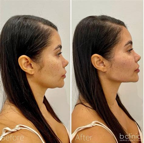 Non Surgical Jaw Enhancement Dermal Fillers Brisbane And Gold Coast
