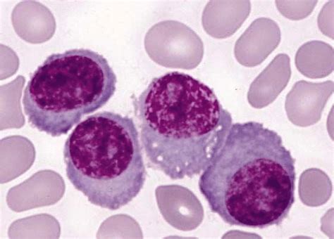 Peripheral Blood Smear With Secondary Plasma Cell Leukemia