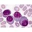 Peripheral Blood Smear With Secondary Plasma Cell Leukemia Or Leukemic 