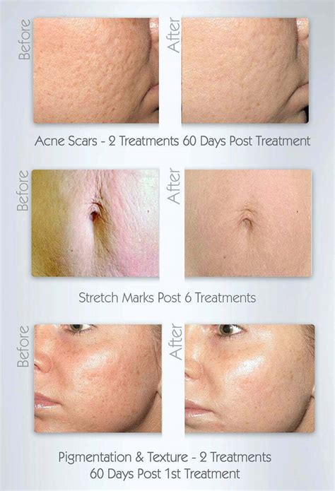 Before And After Collagen Pin Skin Perfection Skin Perfection