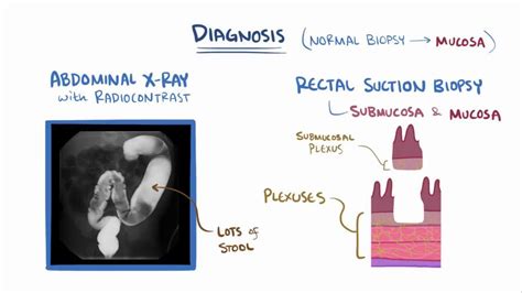 hirschsprung disease video anatomy and definition osmosis