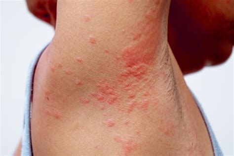 Erupción Alérgica Del Problema De La Dermatitis Problema De La Piel