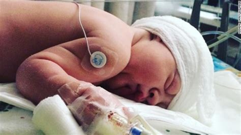 Utah Baby Born Without Skull In The Back Of His Head Defies Odds