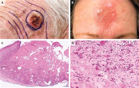 Squamous Cell Carcinoma Of The Skin Nejm