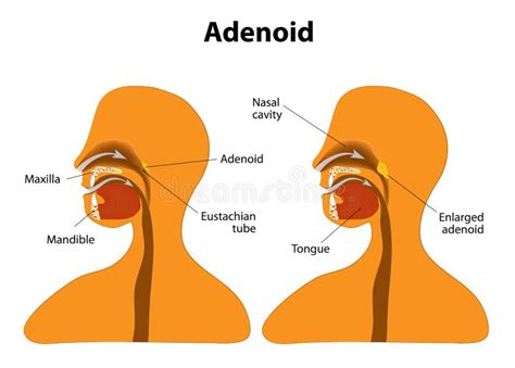 Adenoideo Adenoide Normale Ed Ingrandetta Illustrazione Vettoriale
