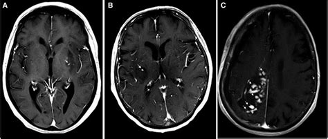 Spot Sign In Acute Intracerebral Hemorrhage In Dynamic T1 Weighted
