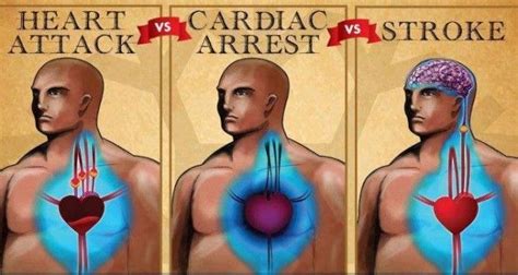 Learn The Key Differences Among Cardiac Arrest Heart Attack And Stroke
