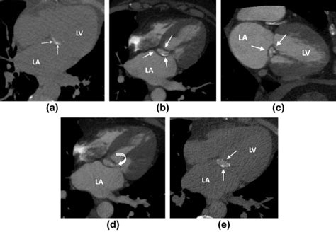 Multidetector Ct Assessment Of Caseous Mitral Valve Calcification With