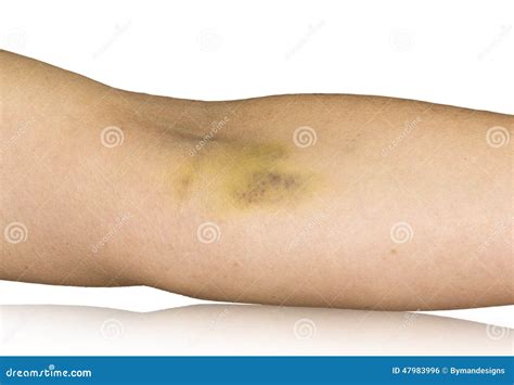 Bruise On Hand Stock Photo Image Of Contusion Hand 47983996