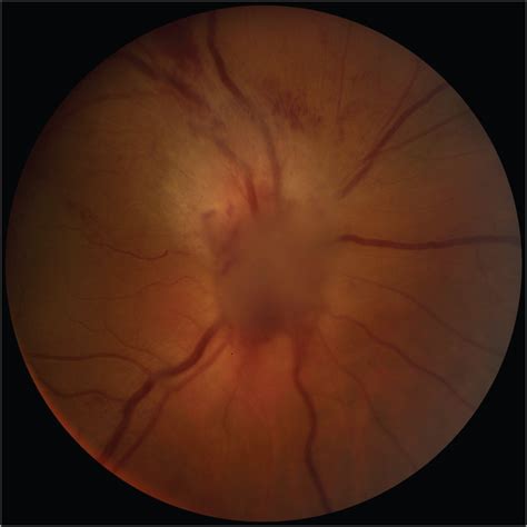 More Than Just Optic Disc Swelling Infectious Diseases Jama