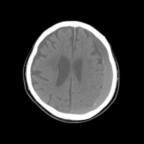 Contralateral Delayed Acute Subdural Hematoma Following Evacuation Of A