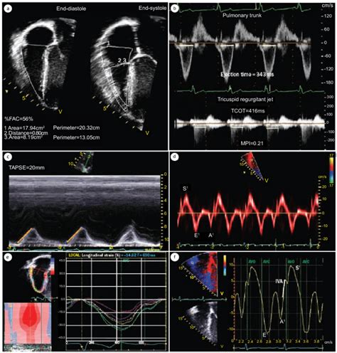 Assessment Of Right Ventricular Rv Function By Echocardiography A