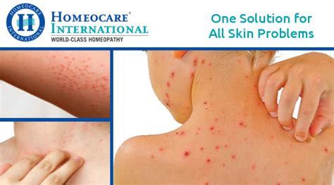 One Solution For All Skin Diseases Homeocare International