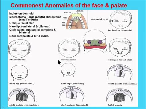17 Commonest Anomalies Of The Face Palate Youtube