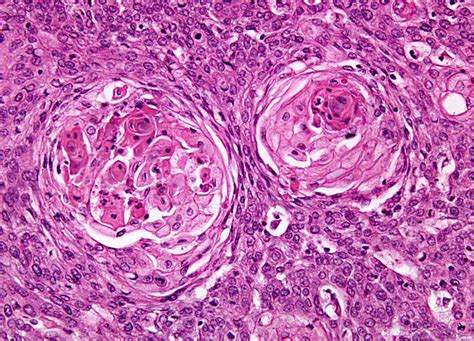 Squamous Cell Carcinoma At 20x Magnification Nikons Microscopyu