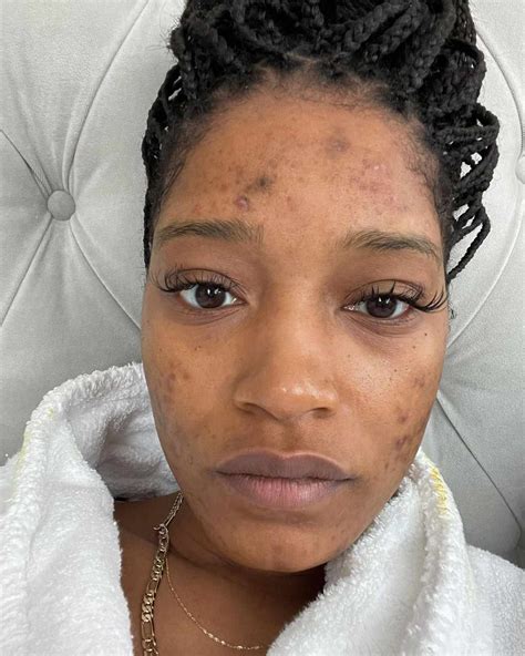 Keke Palmer Shows Her Acne After Learning She Has Pcos