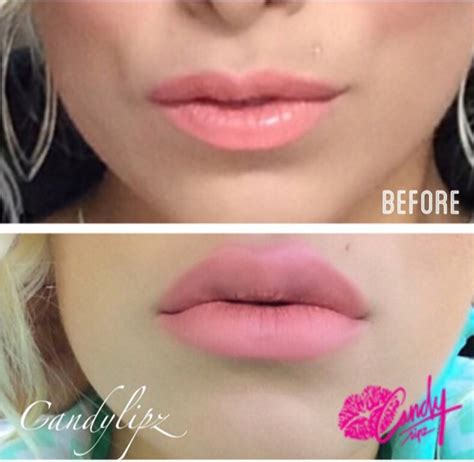Does the plump it lip plumper actually work?! CandyLipz Lip Plumper Before and After Reviews ...