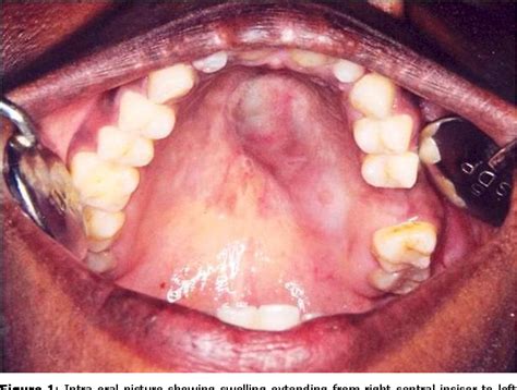 Figure 1 From Adenoid Cystic Carcinoma Of The Palate Case Report And